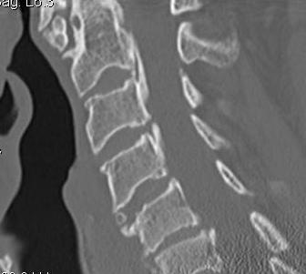 OPLL Cervical Spine